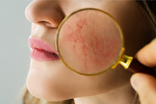 Examining Face Skin With Rosacea Problems