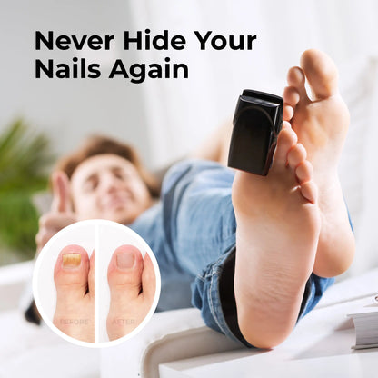 MicroRemedy Light Therapy Nail Restoration Device 